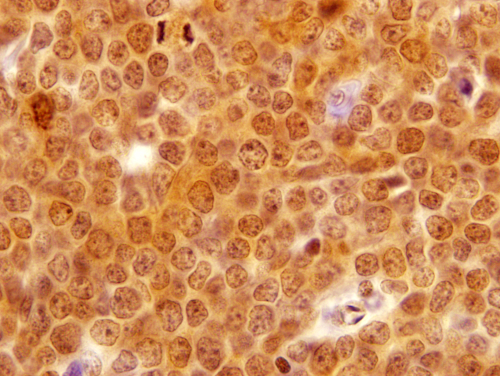 NPM immunohistochemical staining: Abnormal cytoplasmic localization